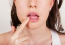 Заеды в уголках губ: каких витаминов не хватает, другие причины появления проблемы